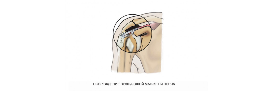 Повреждение вращательной манжеты плеча