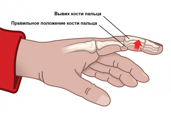 Вывих пальцев руки