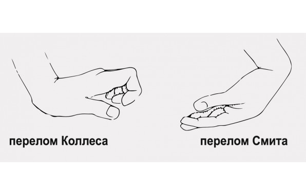 Перелом запястья