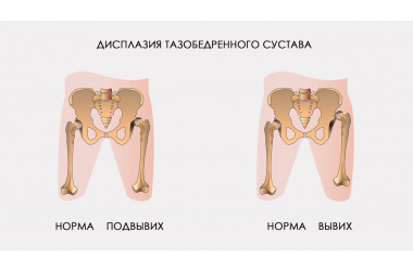 Дисплазия и вывих тазобедренного сустава