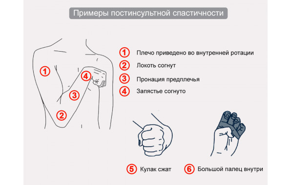 Постинсультная спастичность