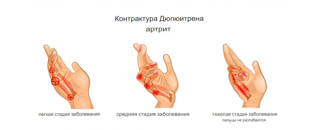 Болезнь Дюпюитрена